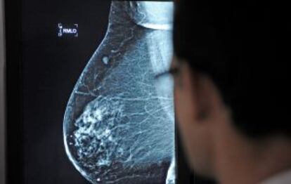 Imagen de un cáncer de mama.