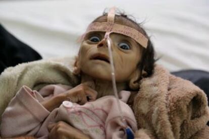 Udai Faisal, que sufría desnutrición aguda severa, murió el 24 de marzo en el hospital Al-Sabeen de Sanaa, en Yemen.