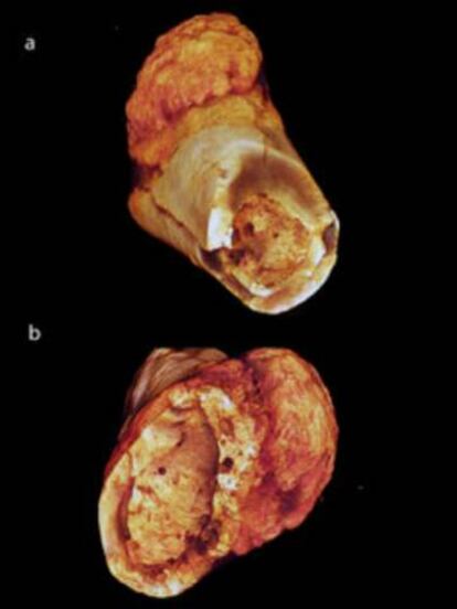 Una vista diferente del tumor del hueso metatarsiano.