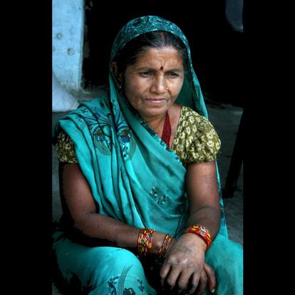 A Ram Kumari Yadav, de unos 45 años (desconoce su fecha de nacimiento exacta), se le salió el útero por su vagina cuando parió a su primogénita. Era una adolescente. Sus padres la casaron tras tener su primera menstruación. "Rápido me quedé embarazada", recuerda. "Después del parto fui unos días a casa de mi madre a descansar y noté que algo se salía. Ella me dijo que era normal después de dar a luz y lo trató de meter de nuevo", relata en voz baja y visiblemente nerviosa. Doce días después volvió a trabajar en el campo y la casa -"si no lo hacía mi suegra me pegaba"-, y el bulto entre sus piernas se fue haciendo más grande. Así, Ram Kumari lleva tres décadas con dolores en la espalda y el abdomen, sin poder sentarse normalmente, ni juntar sus rodillas. Ha parido otros cuatro hijos y sigue haciendo todas las labores del hogar. "Me siento muy triste, me pregunto por qué me pasa esto". Como ella, 600.000 mujeres en Nepal (el 10% de la población femenina) sufren prolapso uterino, de las cuales un tercio necesita una operación. Muchas no se la pueden hacer aunque es gratuita porque sus maridos no les conceden la ciudadanía, obligatoria para que el Estado les realice la intervención. El esposo de Ram Kumari no solo se lo impide porque no quiere dejar de mantener relaciones sexuales durante los días de reposo tras la cirugía sino que, además, le pega cuando llega borracho a casa. Pese a sus historias comunes y aunque viven a escasos pasos unas de otras, las mujeres no hablan de sus problemas, mucho menos de si tienen prolapso. "No conozco a otras que lo tengan. Y mis vecinos no saben mi problema, y si lo supieran no me sentiría bien. Nadie habla de esto. La gente no abre su corazón".