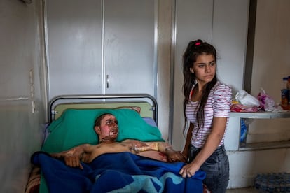 Ahmed Ibrahim, de 18 anys, de les Forces Democrtiques de Sria, greument cremat, rep la visita de la seva parella en un hospital a Al-Hasakah (Sria), el 20 d'octubre del 2019.