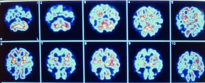 Im&aacute;genes de un cerebro con alzh&eacute;imer.