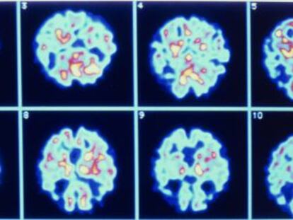 Imagens de um cérebro com Alzheimer.