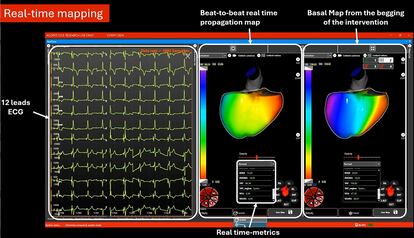 Funcionamiento del Corify que mapea la actividad eléctrica del corazón en tiempo real.