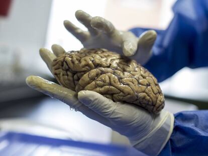 Uno de los cerebros donados para el estudio de la mutación E280A, en la Universidad de Antioquia, en Medellín (Colombia).