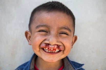 Gabo, de cuatro años, sonríe a cámara días antes de su operación. Su familia ha estado esperando esta intervención desde que nació. Nacer con LPH implica problemas de nutrición y respiratorios, además del estigma y el señalamiento. Todo esto es agravado por la desinformación, la precariedad de la atención médica y el empobrecimiento que supone para las familias más vulnerables.