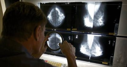 El cáncer de mama mata a 6.000 personas en España al año en España.