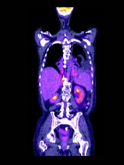 Tomografía de un cáncer de pulmón.