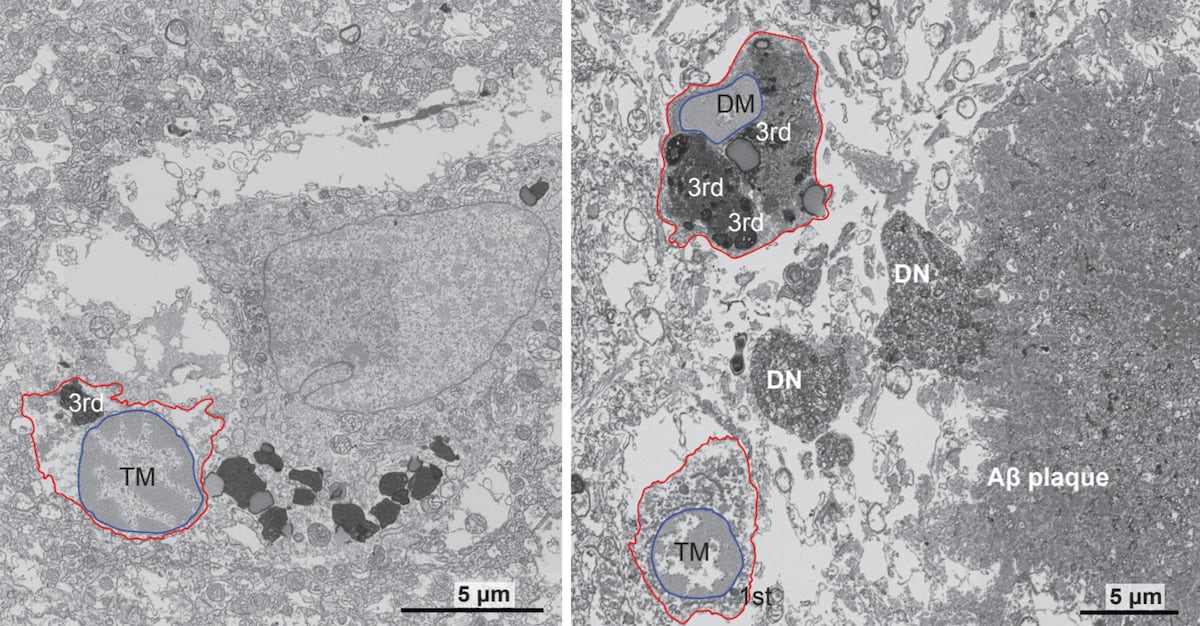 Descubren el papel de la microglía oscura en la neurodegeneración del Alzheimer