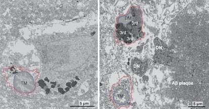 Imgenes de microscopio electrnico de la microgla del cerebro de una mujer sana de 92 a?os (izquierda) y de la microgla oscura de una paciente de alzhimer de 91 a?os.