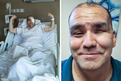 Jaime Díaz de León, de 48 años, fue diagnosticado por hongo negro en el Estado de Chihuahua