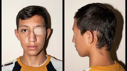 Nicolás Bernal, de 13 anos, sofreu um traumatismo craniano durante os protestos pelo impacto de uma granada de gás lacrimogêneo, em Bogotá, Colômbia. CAMILO ROZO