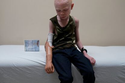 Baraka Lusambo, un tanzano albino al que le cortaron el brazo durante un ataque, después de la colocación de su brazo protésico en el hospital Shriners de Filadelfia, Pennsylvania.