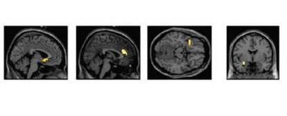 ACTIVACIÓN DE ZONAS DEL CEREBRO EN UNA TAREA DE RECONOCIMIENTO DE EMOCIONES (IRA Y MIEDO) EN FUNCIÓN DEL GENOTIPO DE LA ENZIMA MAOA. EN LAS PERSONAS CON MAOA DE BAJA ACTIVIDAD SE ACTIVAN MENOS UNAS ZONAS Y MÁS OTRAS (TODAS ELLAS RELACIONADAS CON LA RESPUESTA A ESTÍMULOS SOCIALES AVERSIVOS) QUE EN LOS PORTADORES NORMALES.