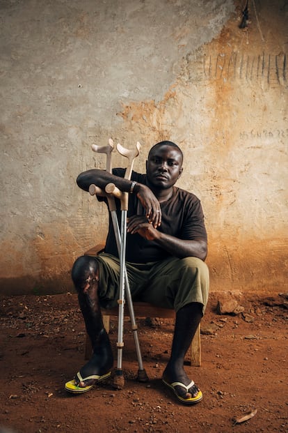 Kikoun Coulibaly sufre una discapacidad que le impide estirar por completo su pierna derecha, afectada por la úlcera de Buruli que no fue tratada a tiempo.