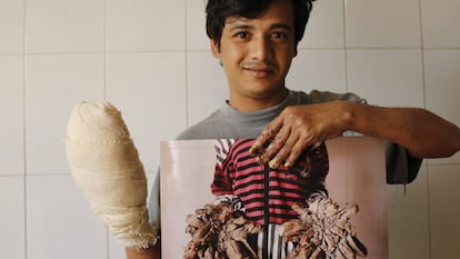 Abul Bajandar, conocido como 'hombre árbol', muestra una fotografía de sus manos antes de ser operadas.