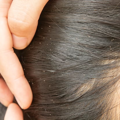 Lice in hair and egg lice and comb on white background