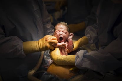Un bebé nacido deun parto por cesárea.