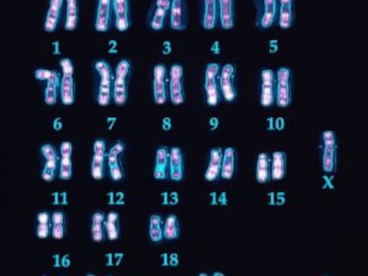 Cromosomas de un varón con síndrome de Down donde se ven las tres copias del 21.