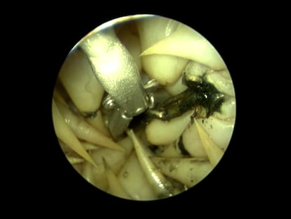Endoscopia a una tortuga boba para extraer un anzuelo de su esófago