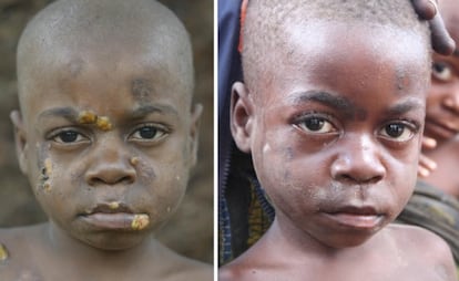 Un niño pigmeo, antes y después del tratamiento contra el pian.