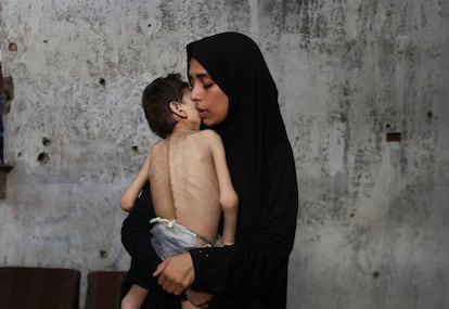 Samah Matar segura seu filho Yousef, que sofre de paralisia cerebral e apresenta sinais de desnutrição. Fotografia tirada em 24 de julho na Cidade de Gaza.  
