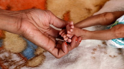 Un niño con desnutrición en un hospital de Saná, Yemen.