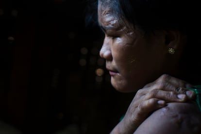 Than Than Ei, ahora con 16 años, muestra sus cicatrices como testimonio del abuso que ha sufrido por parte de su familia adoptiva. Es el último caso de abuso infantil que intenta presionar al gobierno de Myanmar. En la imagen, Than Than Ei muestra sus cicratices en la cara y parte superior del cuerpo, mientras se recupera en casa de unos familiares en el sur de Yangon.