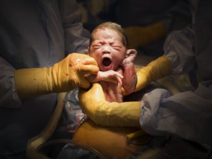 Un niño naciendo mediante cesárea