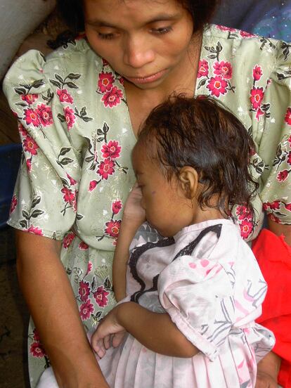 La pequeña Gloria Esperanza padece desnutrición aguda.