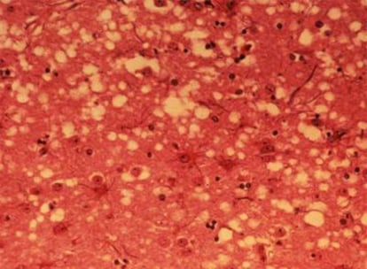 Tejido de cerebro afectado por la encefalopatía espongiforme bovina.