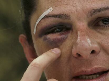 Ana Gabriela Guevara shows her shattered cheekbone.