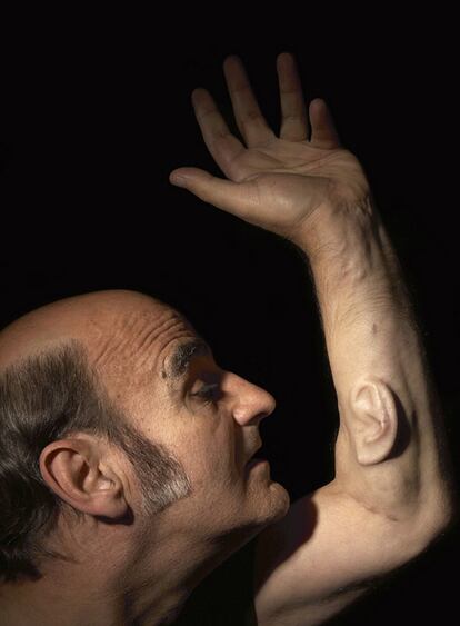 La oreja implantada en el brazo del artista australiano Stelarc funciona.