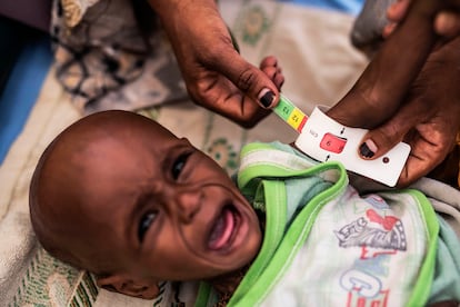 El personal del hospital de Trocaire, en Dolow, ajusta al brazo de un niño la cinta métrica que utilizan para determinar si los pequeños están desnutridos. El tramo rojo indica que puede padecer desnutrición grave.