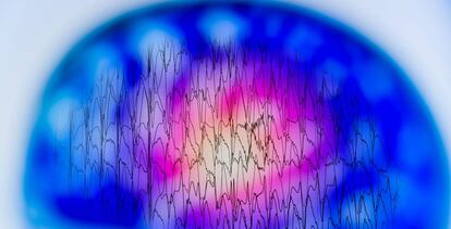 Un electroencefalograma con anomalías en la actividad eléctrica del cerebro.
