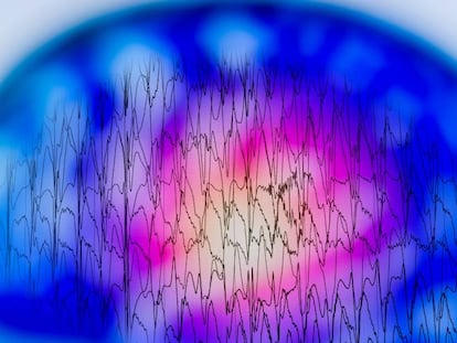 Un electroencefalograma con anomalías en la actividad eléctrica del cerebro.