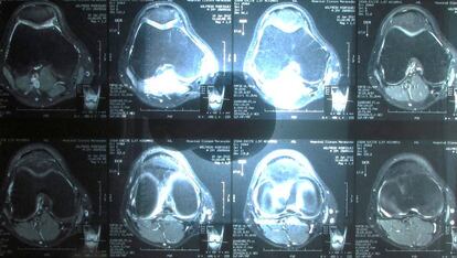 Resonancia magn&eacute;tica de una rodilla.