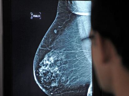 Una mamograf&iacute;a