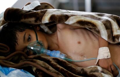 Todo esto llevará a más dificultades para los yemeníes, que ya se enfrentan a una hambruna inminente. En la imágen, Un niño desnutrido de ocho años de edad, tumbado en una cama en la sala de urgencias de un hospital de Saná.
