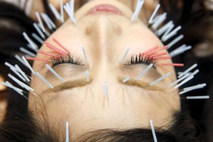 La acupuntura es eficaz para tratar náuseas y cefaleas.