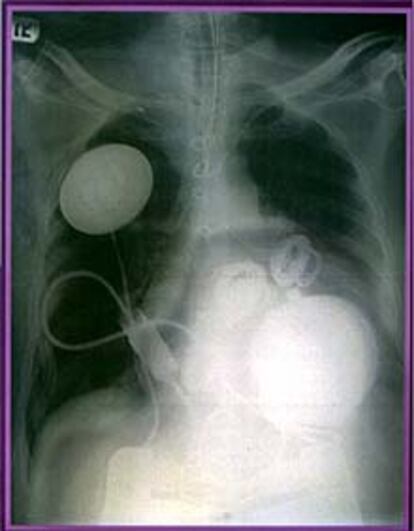 <font size="2"><b>El primer enfermo con corazón artificial sorprende por su rápida recuperación</b></font><p>En la imagen, radiografía del tórax del paciente con su nuevo corazón. (REUTERS)
