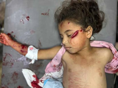 Ghina, de 7 años, es atendida en Urgencias tras haber sido
bombardeada por el ejército israelí. Sufre heridas por metralla en su superficie corporal, con arrancamiento significativo de partes blandas en sus extremidades. (Jan Yunis, 25 de junio de 2025)