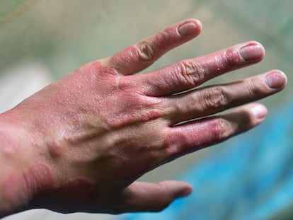 Un paciente con psoriasis en la mano.