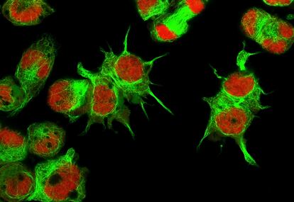 Vista al microscopio de células de neuroblastoma.