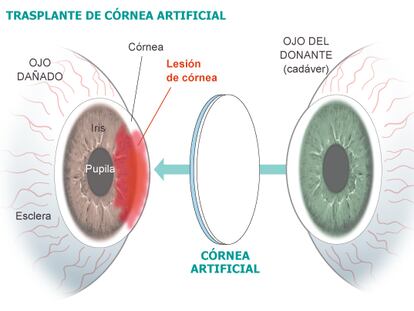 20 pacientes recibirán córneas de laboratorio para recuperar visión