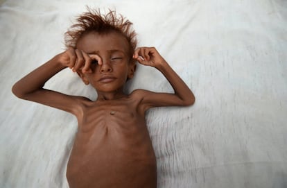 Debido al bloqueo virtual creado por la coalición liderada por Arabia Saudí, más de la mitad de los 28 millones de habitantes de Yemen ya no tienen suficiente comida para una correcta alimentación. En la imágen, un niño desnutrido en Al Hudayda (Yemen).