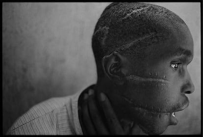 Una de las fotografías más conocidas de James Nachtwey. Un superviviente de los campos de exterminio hutus muestra en un hospital de la Cruz Roja en Nyanza (Ruanda) las cicatrices de los machetazos de sus captores. La instantánea fue tomada en 1994 y recibió el premio World Press Photo a la imagen del año. 