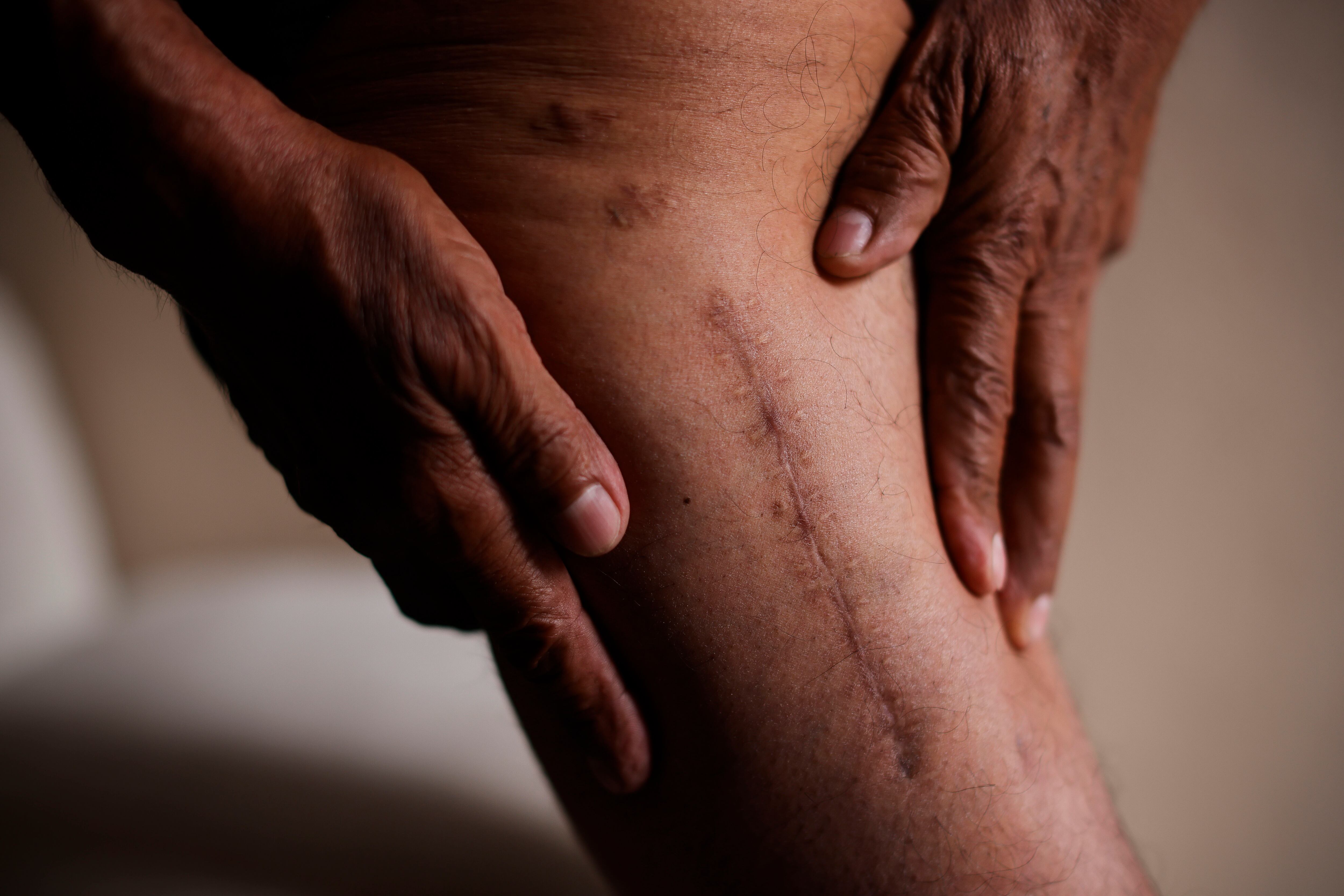 Pedro muestra las cicatrices ocasionadas por las balas tras ser testigo involuntario de un asesinato en las calles de Irapuato en febrero de 2024.