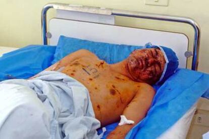 Un herido egipcio yace en el hospital de la ciudad turística.
