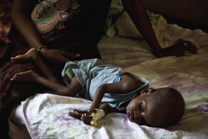Un niño de Mali con desnutrición severa aguda de tipo marasmo (producida deficiencia energética, acompañada de flaqueza exagerada, resultado de un déficit calórico total), ingresado en el centro Ureni de Virimadjo.